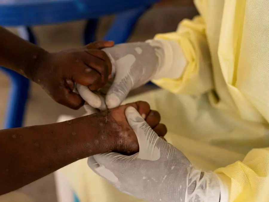 LE MPOX N’EST LE COVID19: L’OMS rassure
